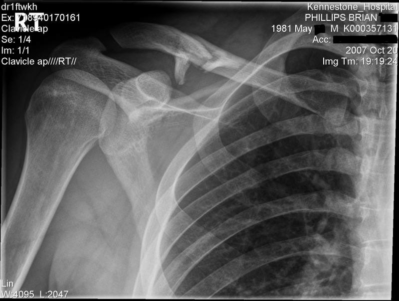shattered clavicle