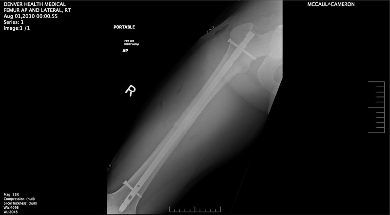 Cam's femur after have the rod put in, you can barely even see the crack.