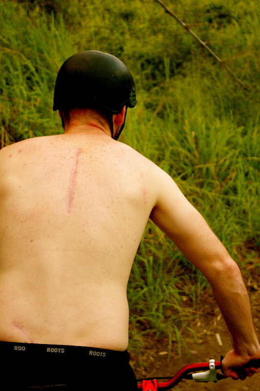 After having a head on collision with a stump in July 2010, doctors cut a bone<br /> out of my hip and used it to repair my back. The helmet I was wearing saved my life.