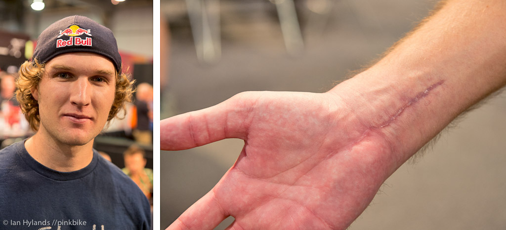 Paul Bas is healing up quickly even the scars look good.